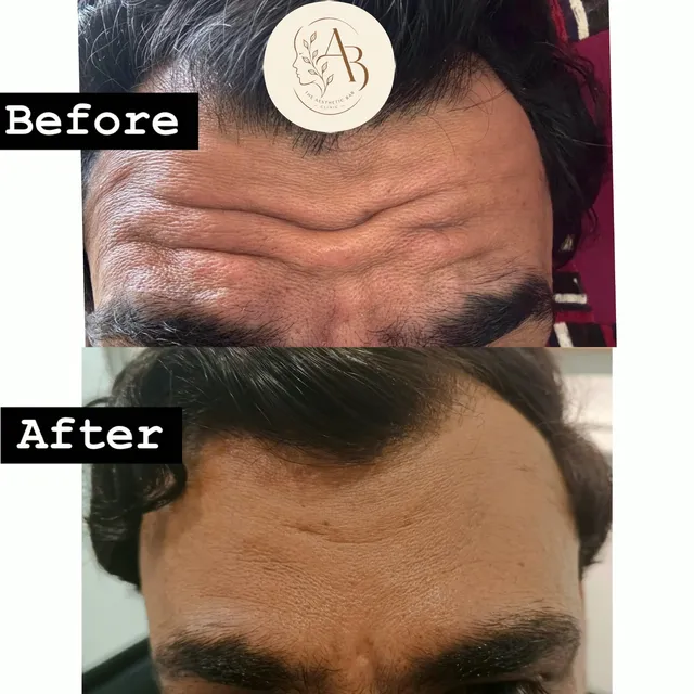 Before and after photograph supplied by The Aesthetic Bar Clinic, showing horizontal lines across a man’s forehead, then a smoother forehead.