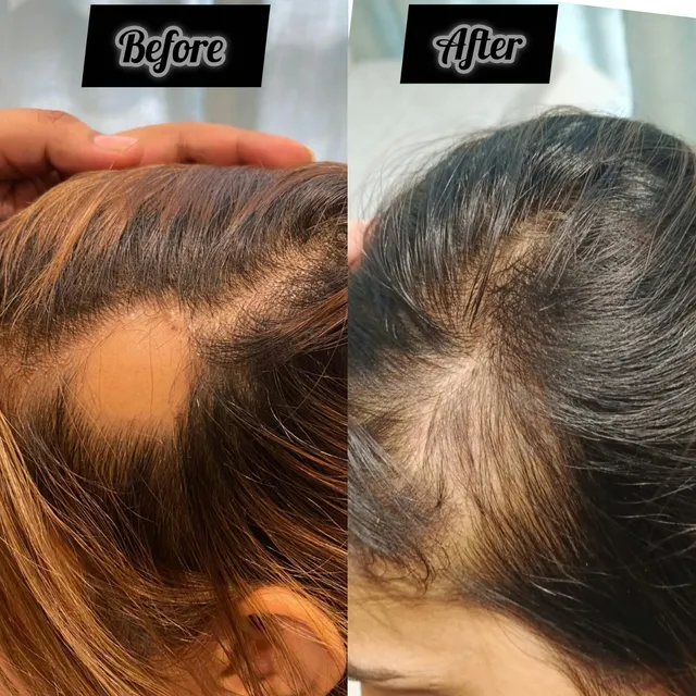Before and after photograph supplied by The Aesthetic Bar Clinic, showing a wide parting in a woman’s hair, then a narrower, denser parting.