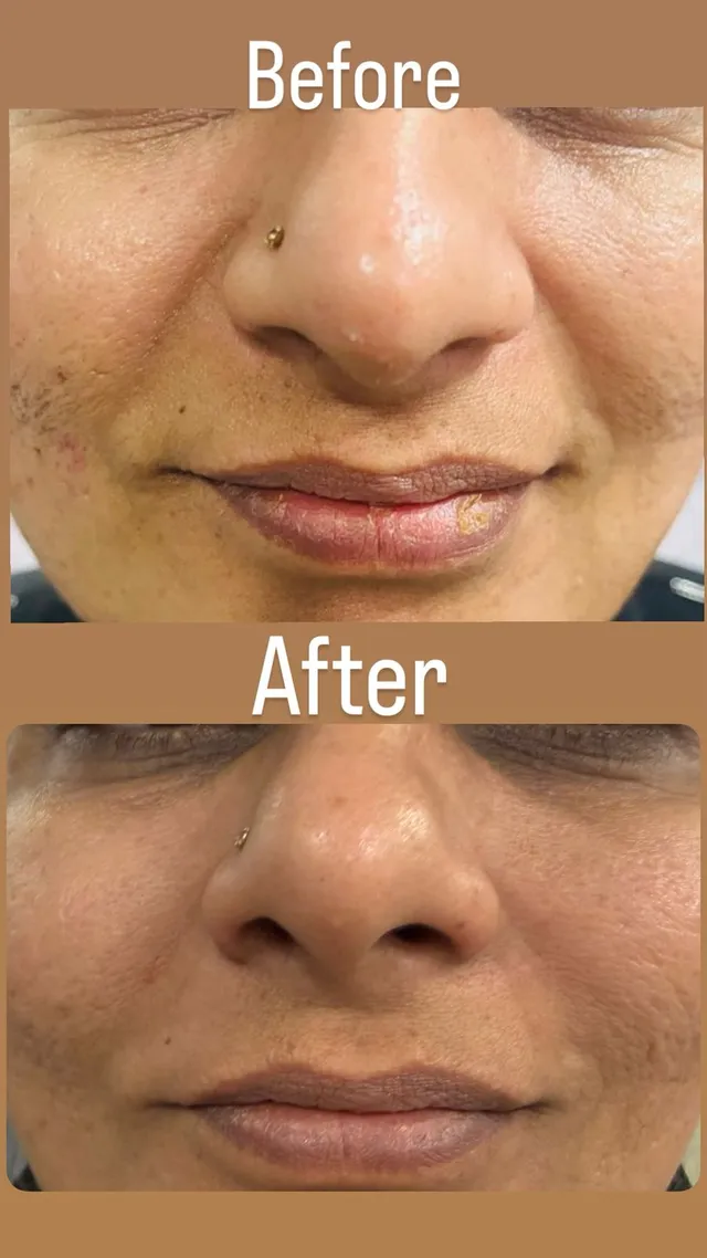 Before and after photograph supplied by The Aesthetic Bar Clinic, showing uneven pigmentation on a woman’s face, then a more even tone.