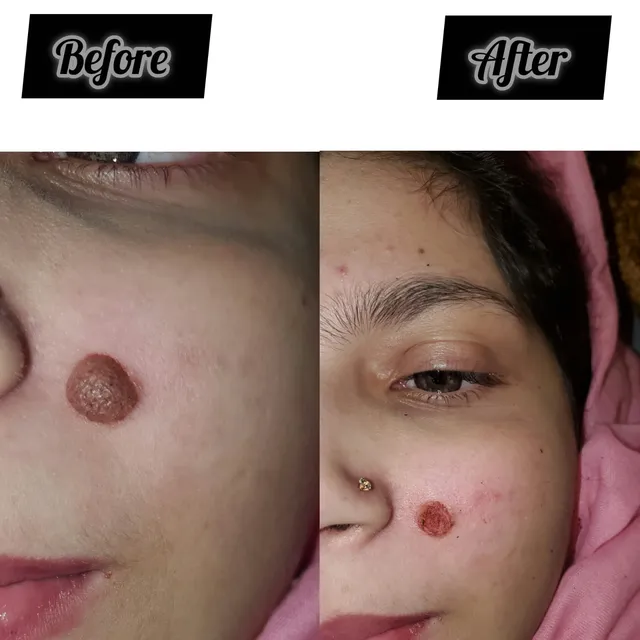 Before and after photograph supplied by The Aesthetic Bar Clinic, showing a raised mark on a woman’s cheek, then a flatter, smaller mark.