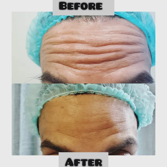 Before and after photograph supplied by The Aesthetic Bar Clinic, showing deep horizontal lines across a forehead, then a smoother forehead.