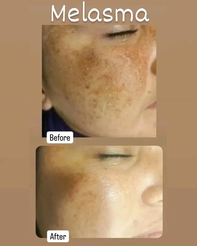 Before and after photograph supplied by The Aesthetic Bar Clinic, showing brown patches on a woman’s cheek, then lighter skin.