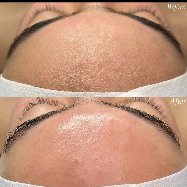 Before and after photograph supplied by The Aesthetic Bar Clinic, showing lines across a forehead and brow, then smoother skin.