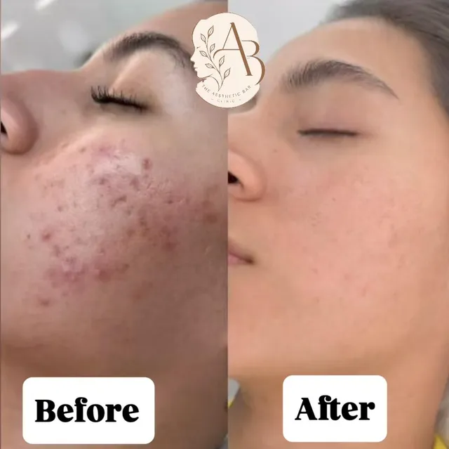 Before and after photograph supplied by The Aesthetic Bar Clinic, showing active spots and marks on a woman’s cheek, then clearer skin.