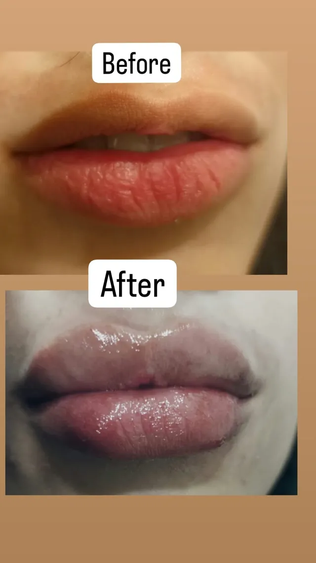Before and after photograph supplied by The Aesthetic Bar Clinic, showing a pair of lips, then fuller lips.