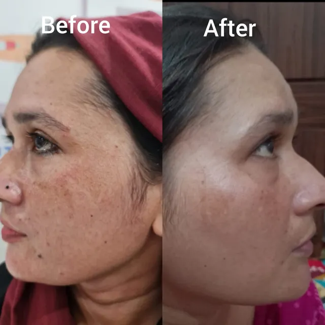 Before and after photograph supplied by The Aesthetic Bar Clinic, showing uneven pigmentation and lines on a woman’s face, then a more even tone.