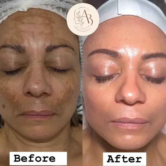 Before and after photograph supplied by The Aesthetic Bar Clinic, showing pigmentation across a woman’s cheeks, then a more even tone.