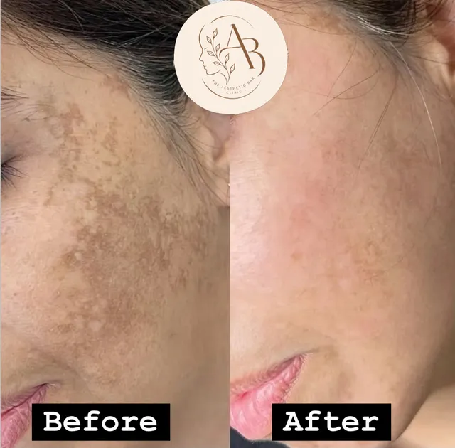 Before and after photograph supplied by The Aesthetic Bar Clinic, showing brown patches on a woman’s cheek, then lighter skin.
