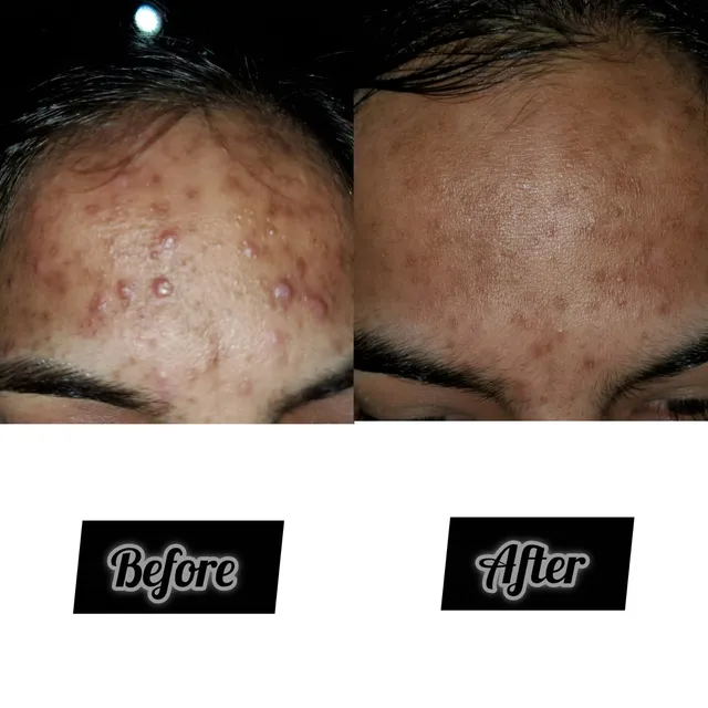 Before and after photograph supplied by The Aesthetic Bar Clinic, showing raised spots across a man’s forehead, then clearer skin.