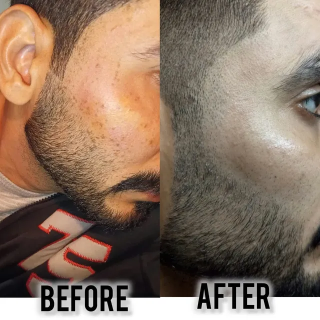 Before and after photograph supplied by The Aesthetic Bar Clinic, showing uneven skin tone along the side of a man’s jaw, then a more even tone.