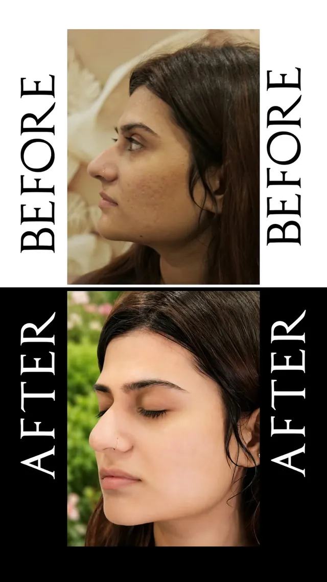 Before and after photograph supplied by The Aesthetic Bar Clinic, showing a woman’s side profile, then the same profile after treatment.