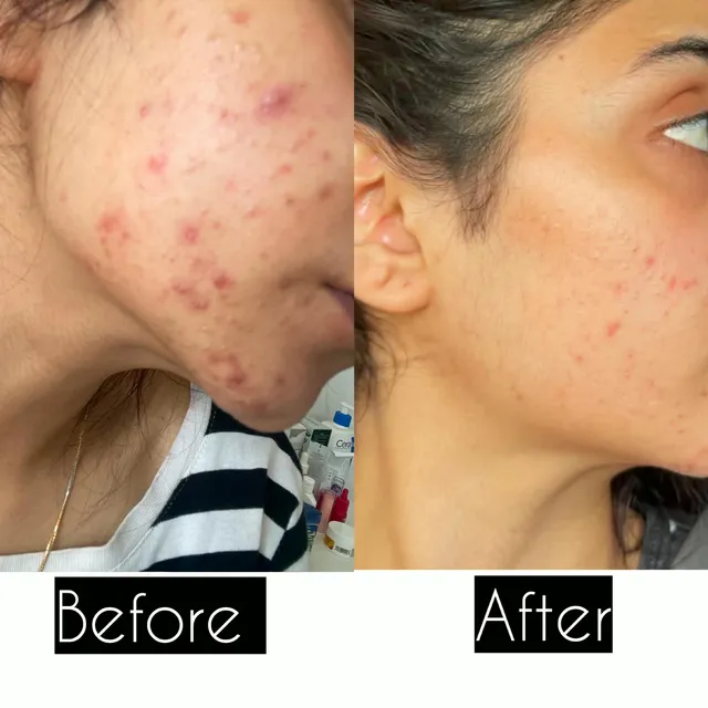 Before and after photograph supplied by The Aesthetic Bar Clinic, showing active spots on a woman’s cheek and jaw, then clearer skin.