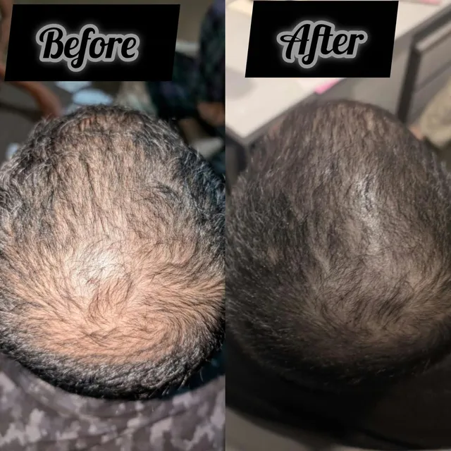 Before and after photograph supplied by The Aesthetic Bar Clinic, showing thinning hair at the crown of a man’s scalp, then denser coverage.