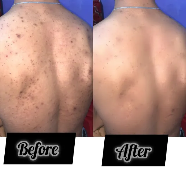 Before and after photograph supplied by The Aesthetic Bar Clinic, showing spots across an upper back, then clearer skin.